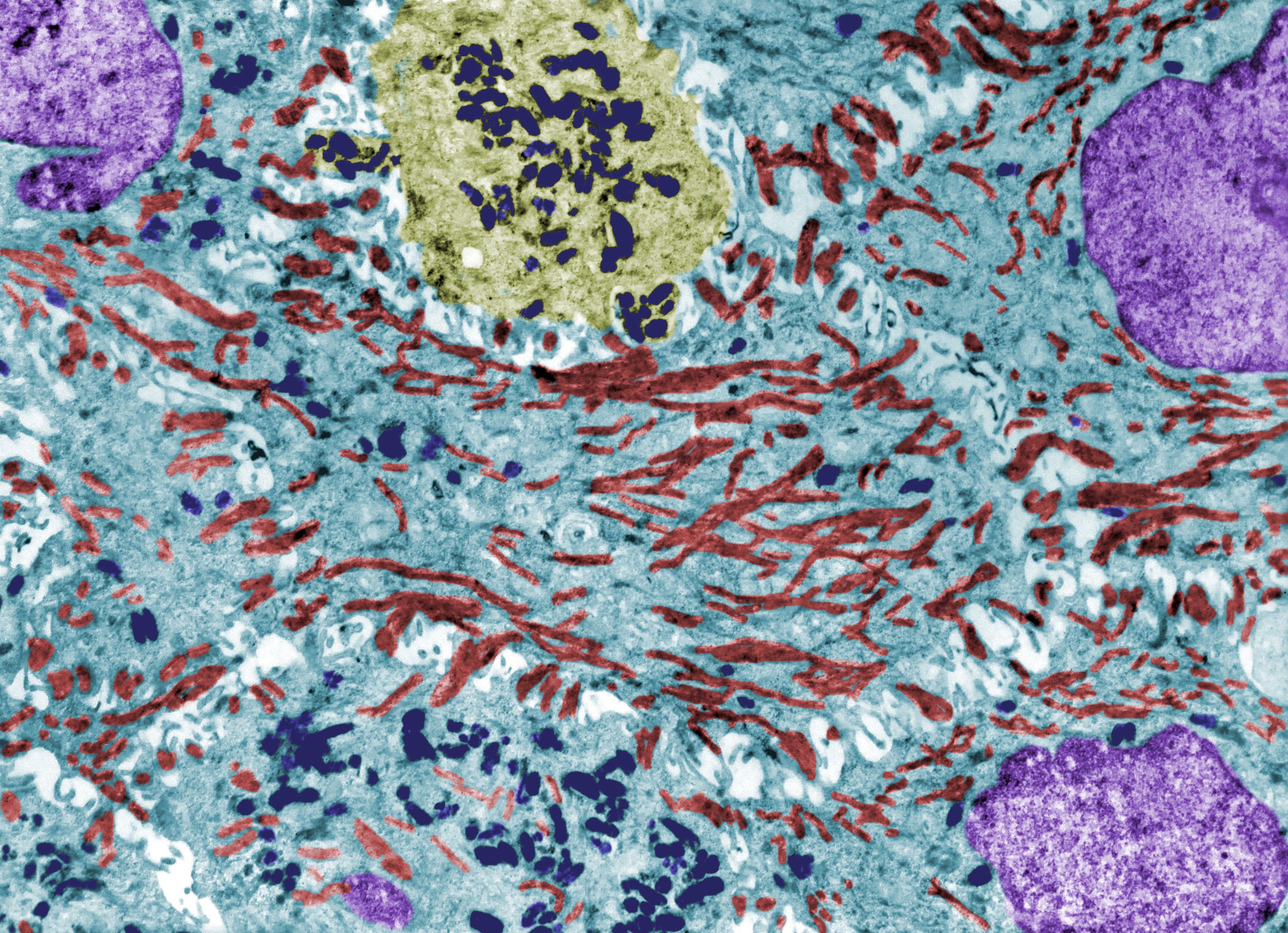 Electron microscope image of keratinocytes and melanin granules in melanocytes