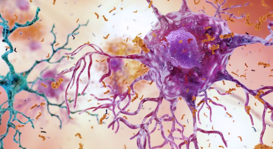 A medical image showing brain inflammation with microglia that fail to clear debris, causing astrocytes to react